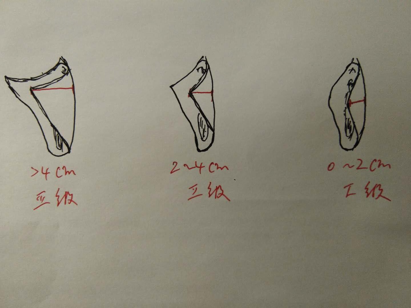 夏天到了,咱们来聊个羞羞的话题——小阴唇整形术
