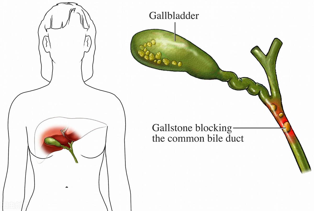 绝不是危言耸听!胆结石腹痛半年不治疗,差点和死神擦肩而过