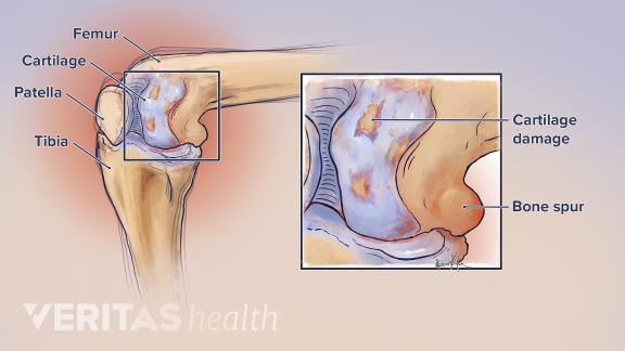 关节膝盖疼吃什么氨糖软骨素,青少年膝盖疼可以吃氨糖软骨素吗