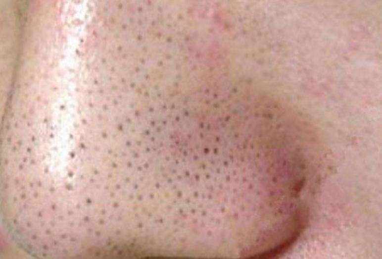 去黑头还不伤鼻子的方法,去黑头妙招分享一招搞定黑鼻头