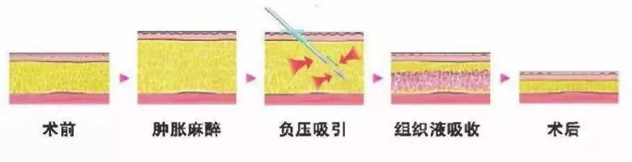 吸脂手术一秒变瘦,做了吸脂手术再减肥还能瘦么