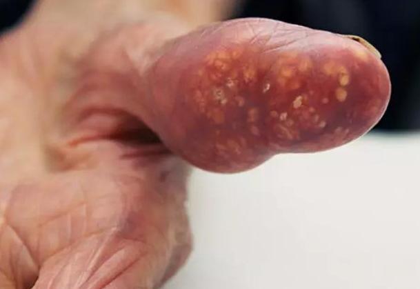 痛风发作期为什么走走症状会减轻,痛风发作期用什么药有效缓解症状