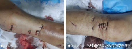 工人撞车在医院抢救视频,工人被车撞到骨折