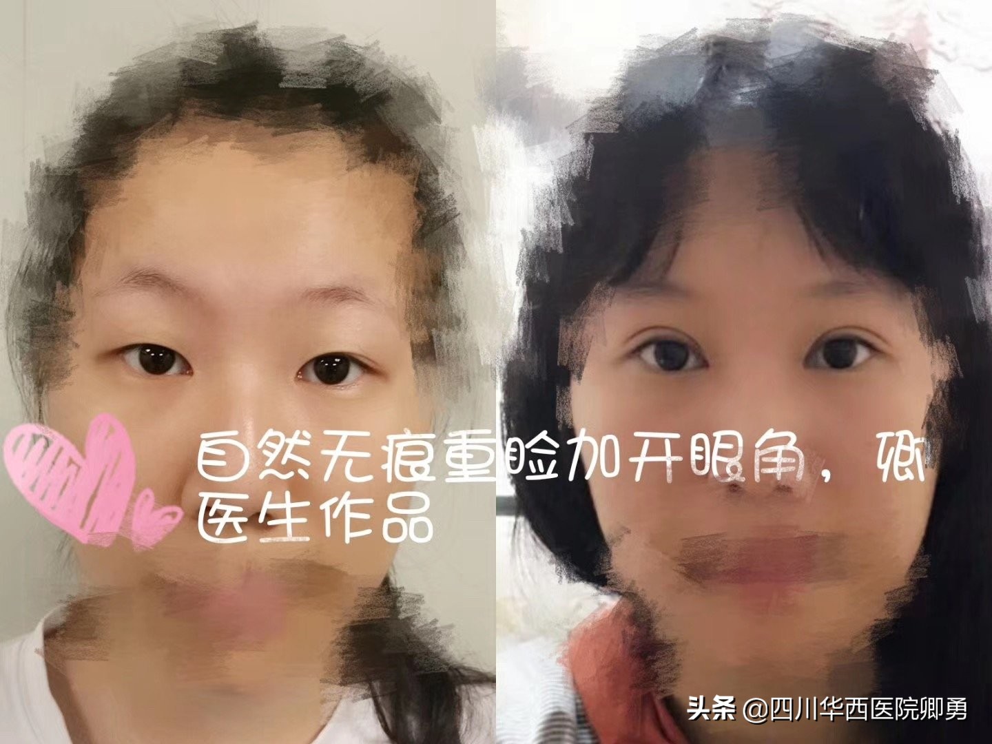 眼部整形的最佳标准,眼部整形可以整成圆眼吗