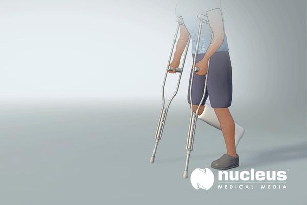 小腿腓骨骨折保守治疗多久能走路,小腿骨折保守治疗多久能恢复正常