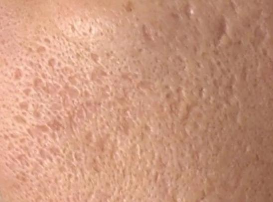 鼻子两侧毛孔粗大是什么原因,毛孔粗大原因及如何改善