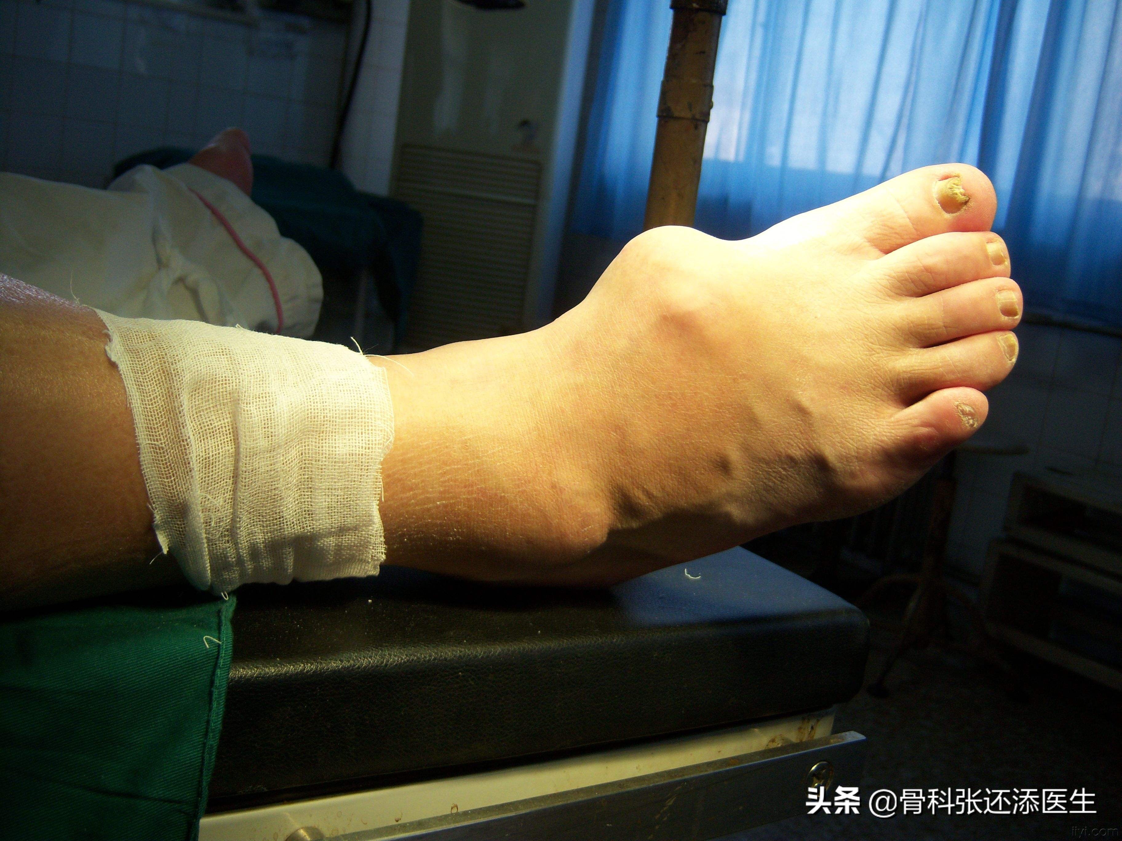 痛风能治愈？尿酸监测，药品选择，除了戒口，我们聊点深入的科普