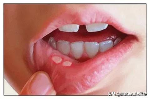 别让口腔溃疡影响过年的心情,复发性口腔溃疡中医防治指导请查收