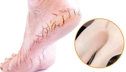 汗脚容易干裂吗,汗脚突然变干脚裂口什么原因