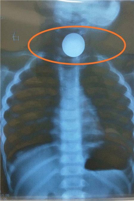 10岁男孩误吞1元硬币卡在喉咙,3岁孩子误吞1元硬币