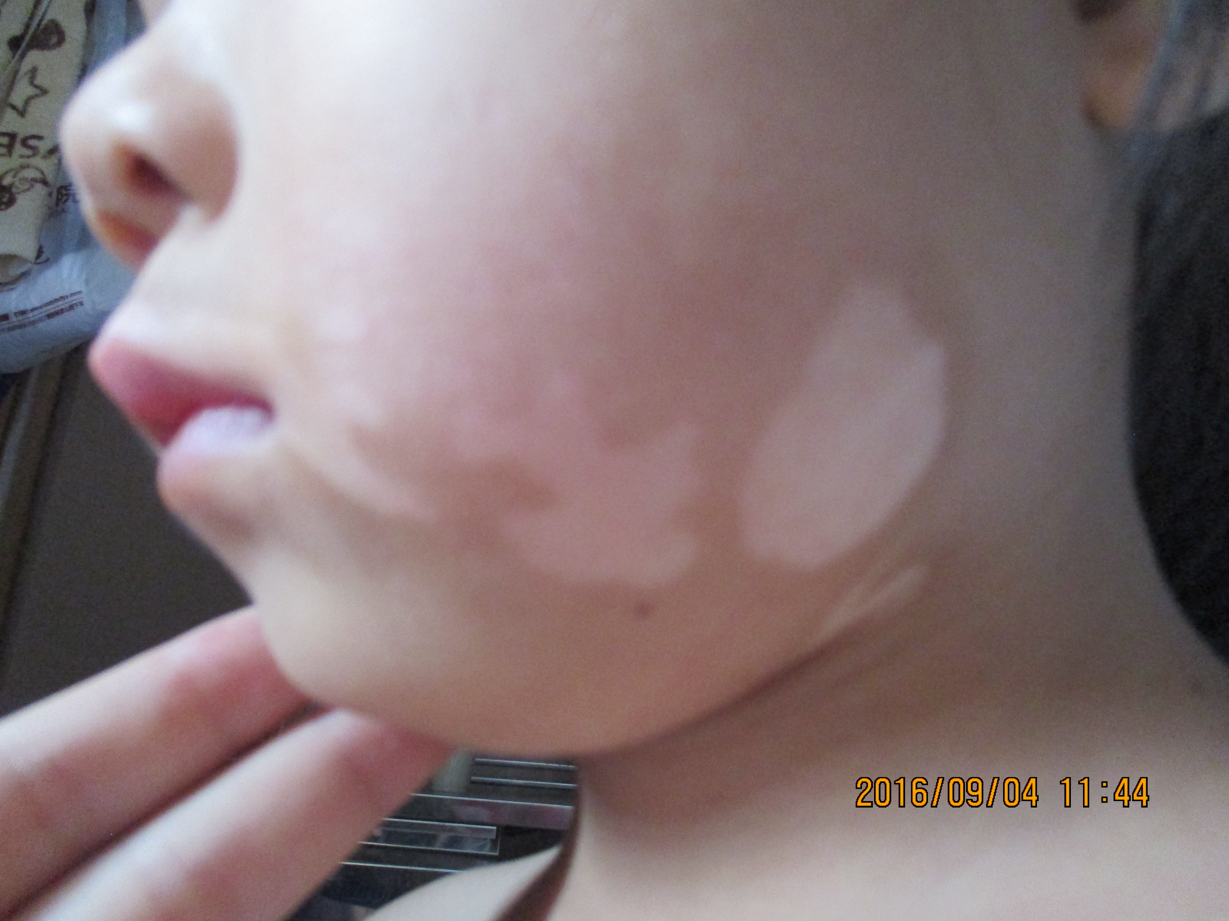 小孩缺锌脸上长的白斑叫什么,小孩脸上长白斑怎么办啊