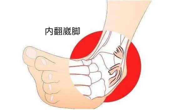 人总是崴脚怎么回事,孩子总爱崴脚怎么回事