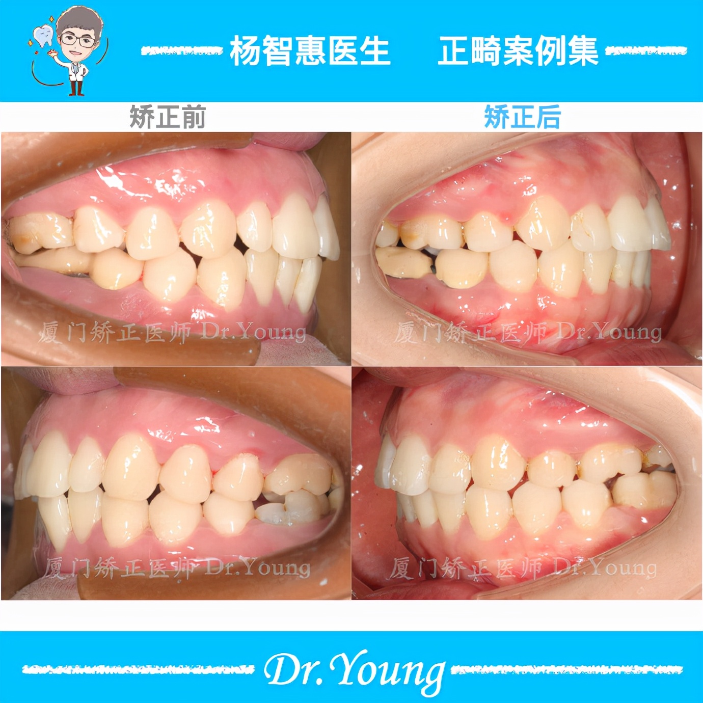 厦门市哪里矫正牙齿最好,厦门牙齿前突去哪里治疗