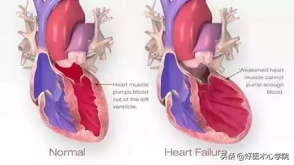 肌钙蛋白升高一定是心梗吗,超敏肌钙蛋白71是心梗还是心肌炎