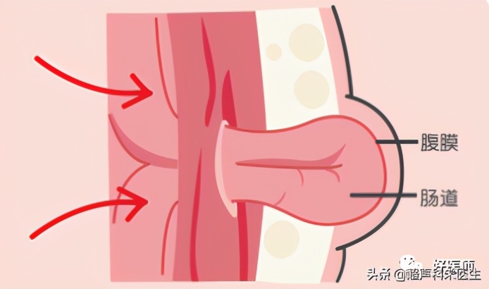 脐带脱落前有黄色分泌物正常吗,脐带脱落后出血新生儿脐带护理