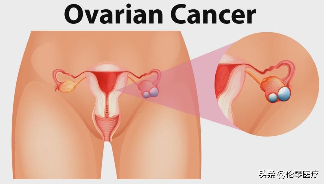2022年恶性肿瘤筛查与预防指南,常见恶性肿瘤的预防和筛检