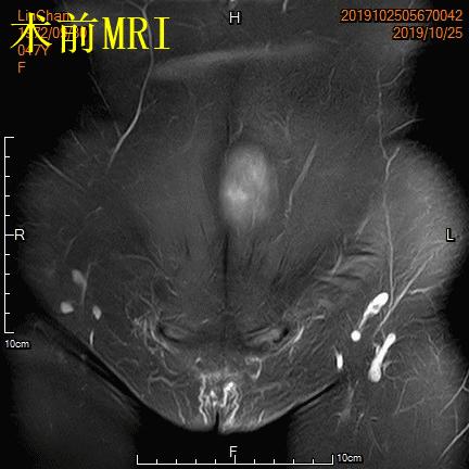 子宫腺肌症「不死的癌症」——介入栓塞来帮忙