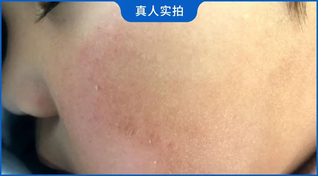 改善小脸泛红的宝宝面霜,婴儿小脸一年四季都嫩的面霜