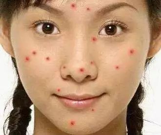 皮肤有斑有痘要做什么样的护理呢,有斑有细纹长痘是什么皮肤