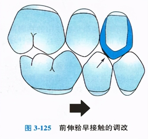 牙体缺损粘接修复术过程,口腔修复学牙体缺损的修复