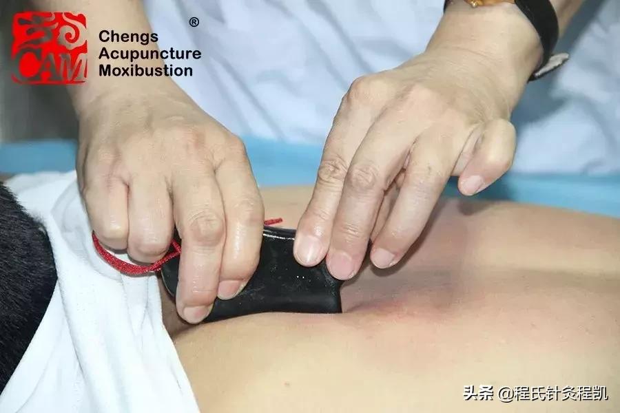 腰痛有寒湿气怎样拔火罐,寒湿腰痛一招解决