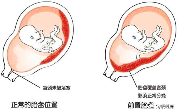 前壁胎盘和前置胎盘有什么区别,前壁胎盘和前置胎盘的区别有哪些