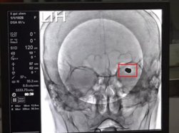 高龄老人脑出血微创手术成功,73岁老人脑动脉瘤破裂开颅手术