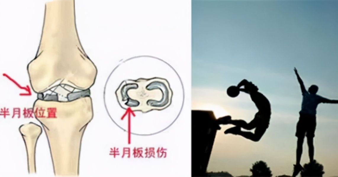 治疗半月板损伤最好的运动办法,运动导致半月板损伤很后悔