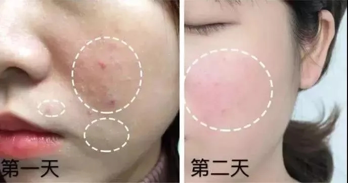 全球公认最好的10款祛痘膏,超好用的一款祛痘膏