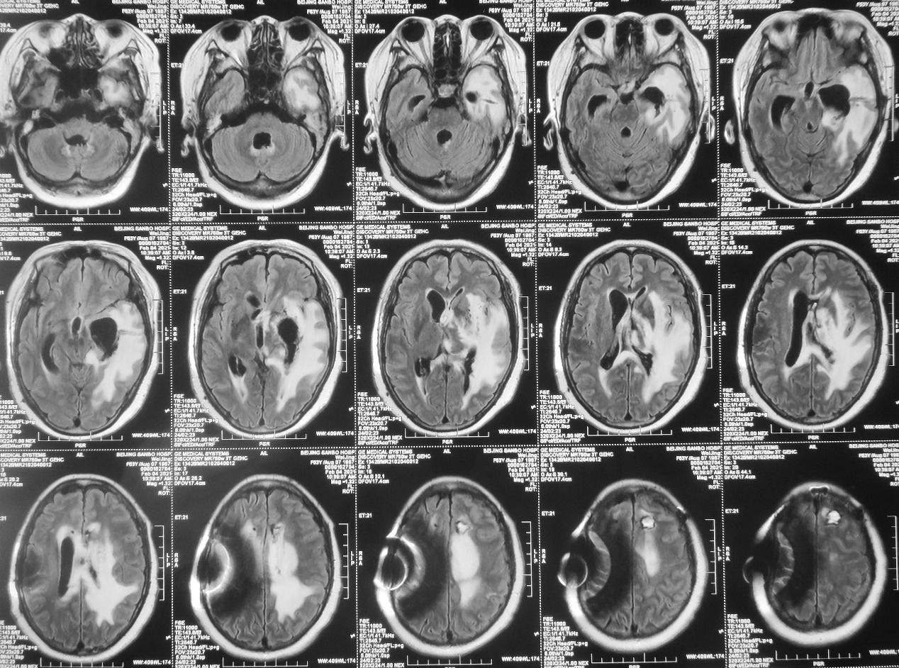 脑脓肿合并脑膜炎需要手术吗,脑脓肿进入左侧脑室严重吗