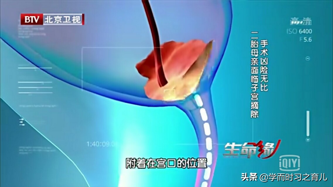 孕早期怎么知道是前置胎盘,孕早期能看出前置胎盘吗