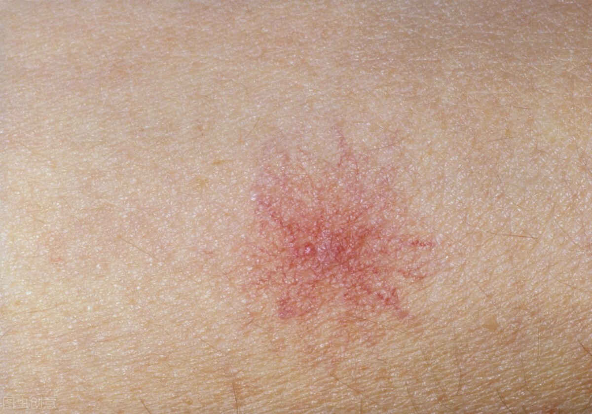 出现肝掌和蜘蛛痣肝功能正常吗,出现肝掌和蜘蛛痣