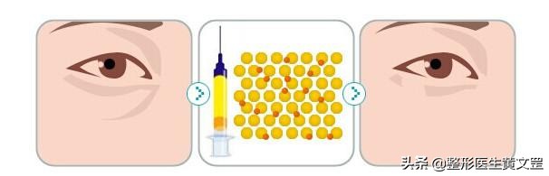 有了泪沟怎么消除,改善显老泪沟试试这3种方法