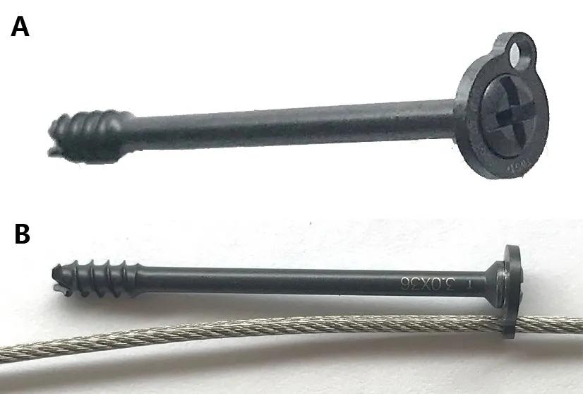 2020三院新技术|异形垫片，纵横连接——髌骨下极粉碎骨折的新选择