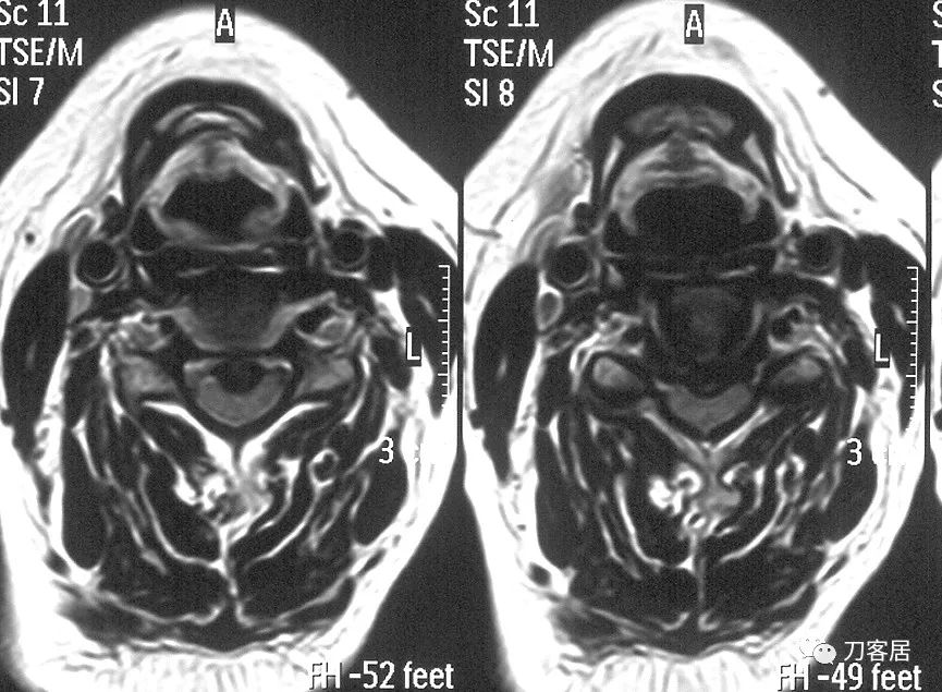脊髓型颈椎病手术后多少天能出院,脊髓型颈椎病手术几天出院