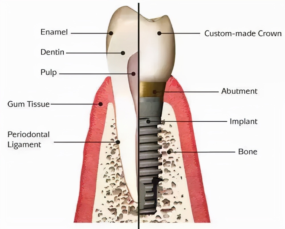 咬硬物导致牙齿松动怎么办,牙齿咬到硬物后破裂要整个拔除吗