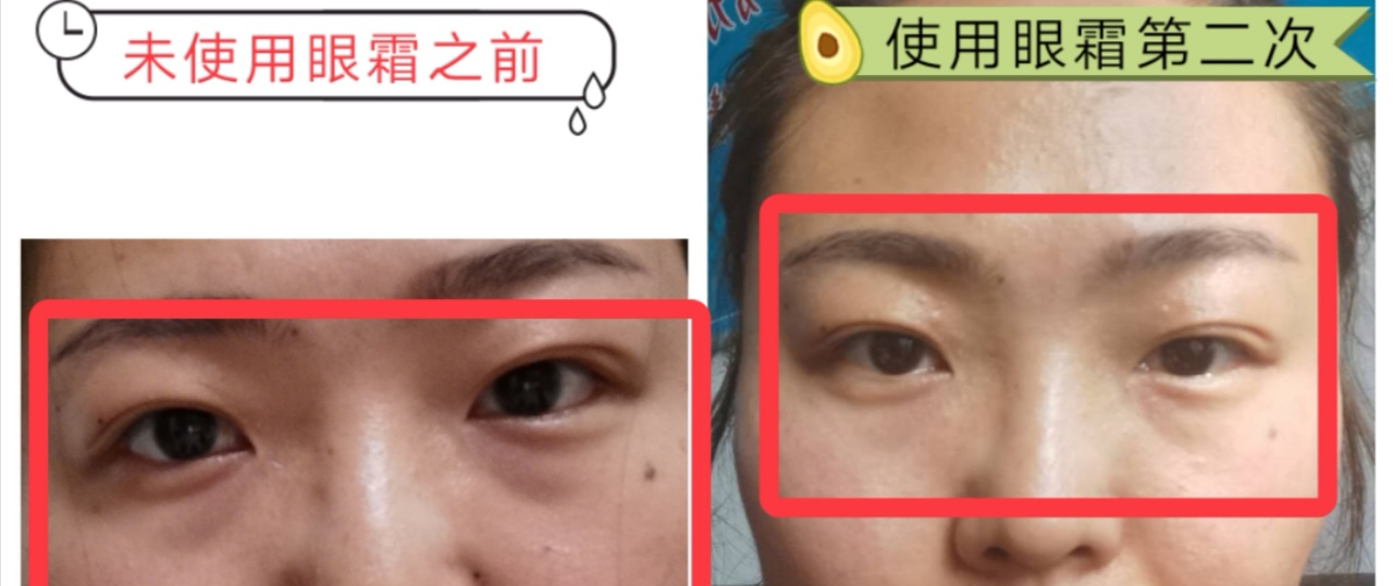 眼袋救星来了,医生推荐眼袋救星