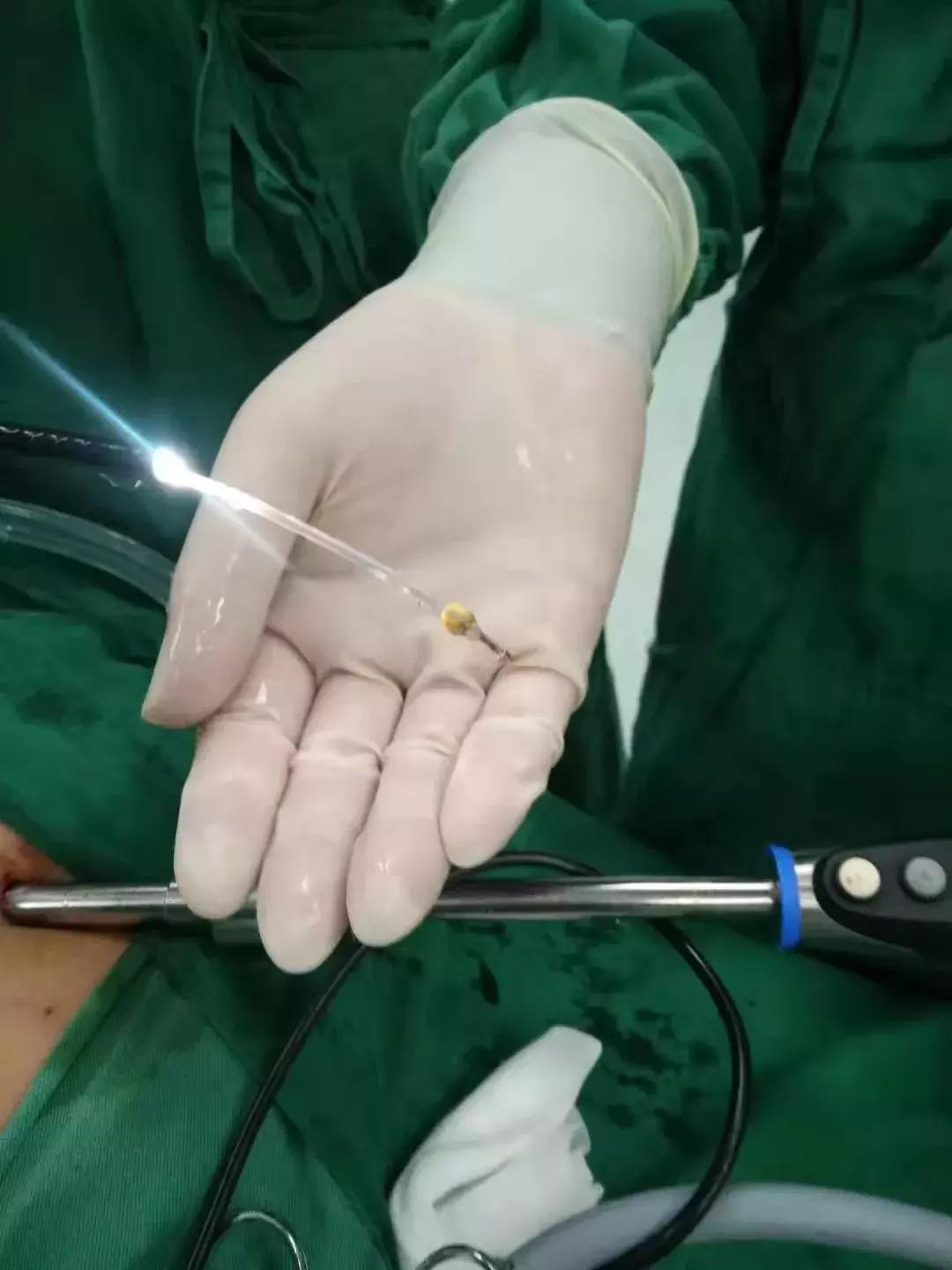 诊断梗阻性黄疸最有效的检查方法,梗阻性黄疸哪种引流方法好