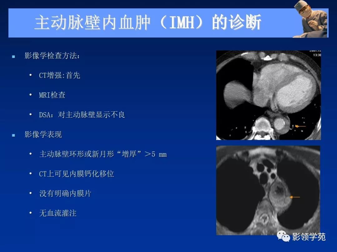 主动脉夹层壁间血肿如何鉴别,主动脉夹层血肿溃疡