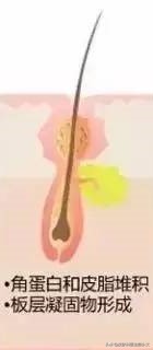 疮可以用针挑掉吗,痘疮净可以祛痘吗