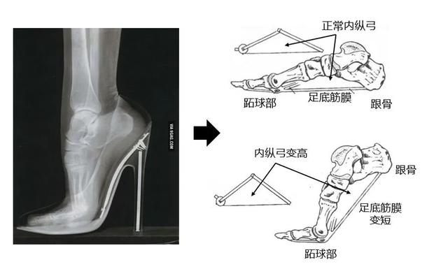 为了美,你愿意上麻药穿红色高跟鞋吗?