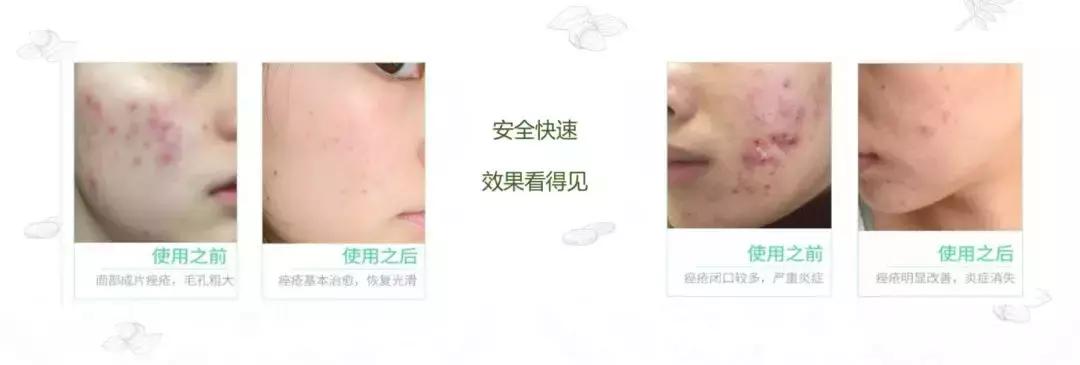 青年祛痘方法,年轻人祛痘的好方法