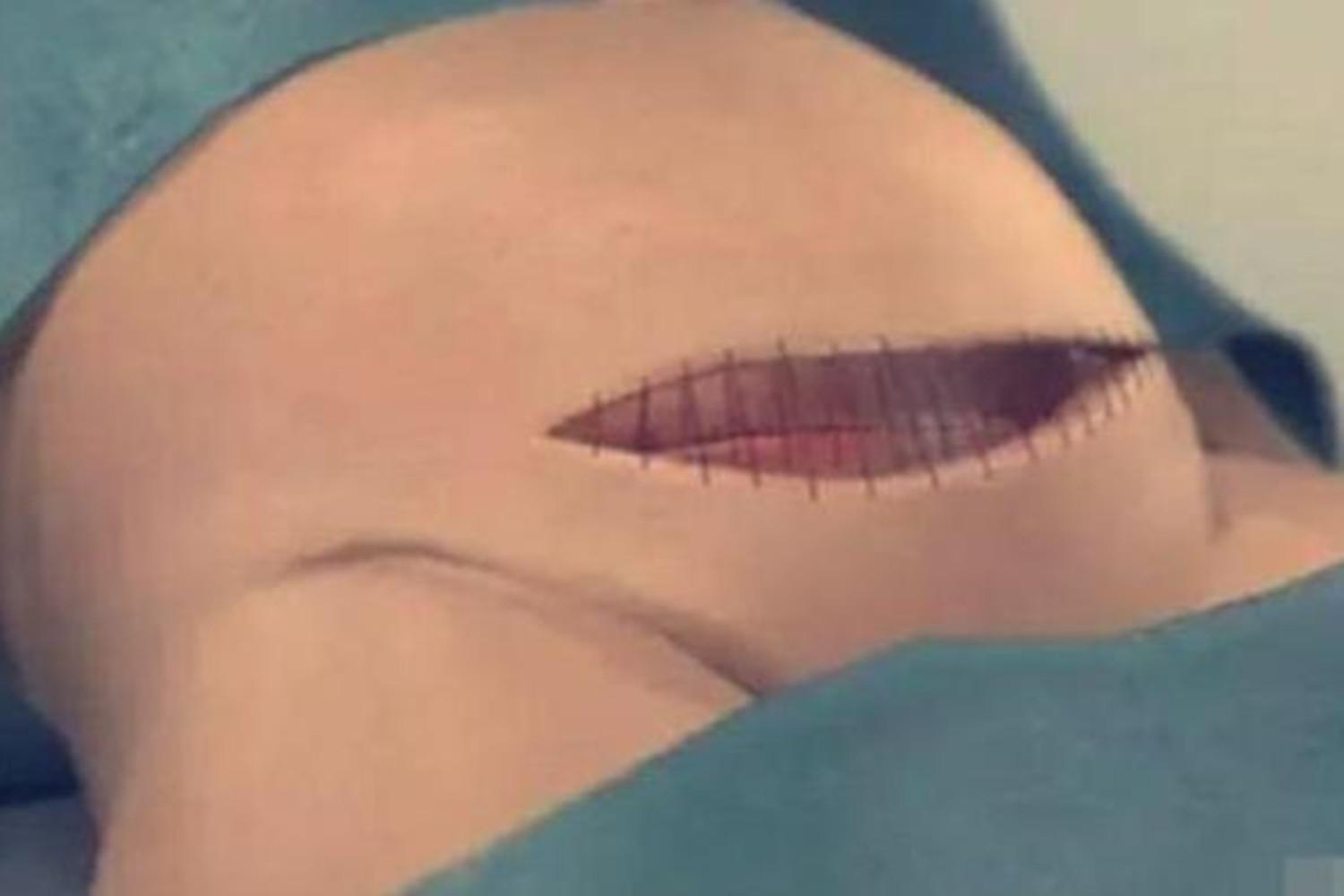 剖腹产肚子上最多能挨几刀,剖腹产完打的肚皮针是什么