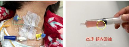 深静脉回血堵管怎么办,深静脉置管抽不出回血怎么办