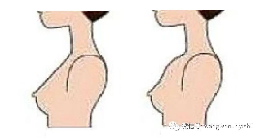 夏天到了胸太小怎么办,夏天到了女生有什么坏心思呢