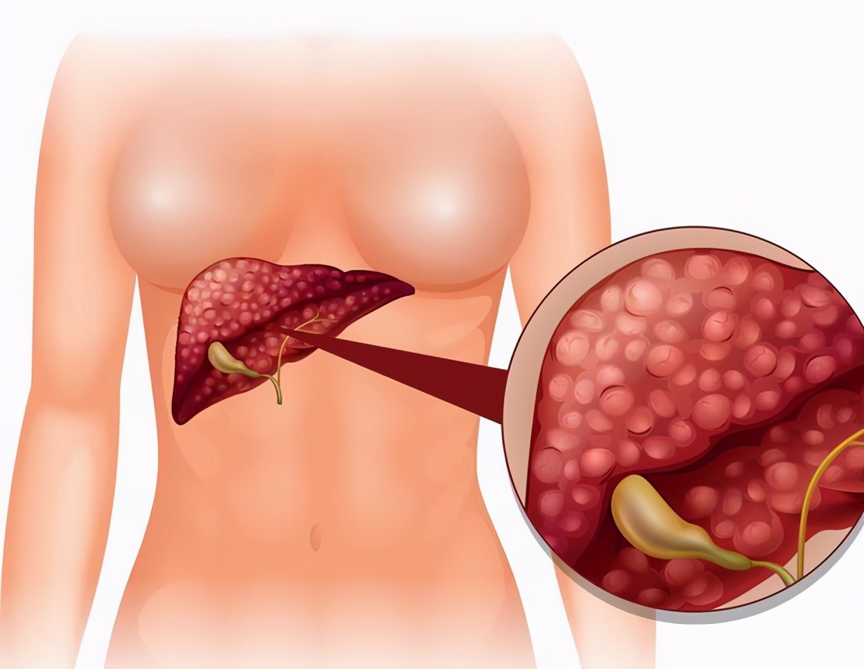 肝癌晚期真的是“无药可治”了吗？不一定，这样做，也可长期生存