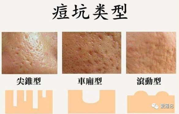 修复痘疤的药,修复痘疤痘坑用什么产品好