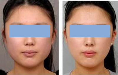 所有人都有咬肌肥大,脸颊咬肌肥大怎么办