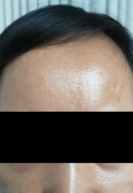 皮肤科医生告诉你，如何让痘痘不再复发