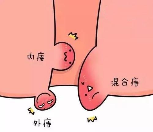 痔疮手术后怎样康复快,有助于痔疮康复的运动
